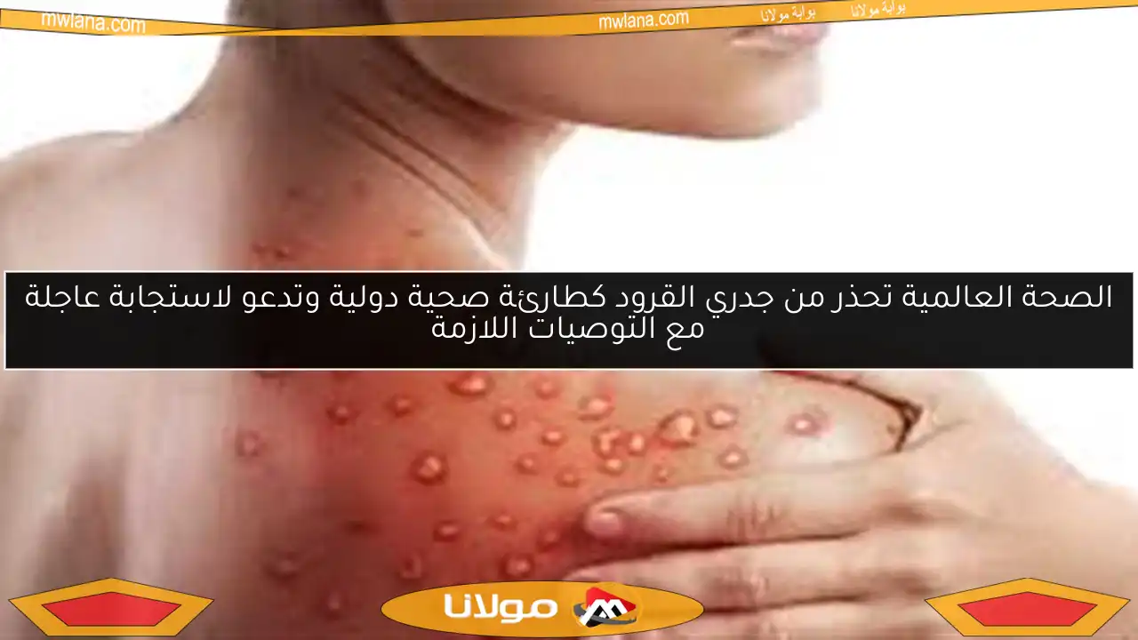 الصحة العالمية تحذر من جدري القرود كطارئة صحية دولية وتدعو لاستجابة عاجلة مع التوصيات اللازمة