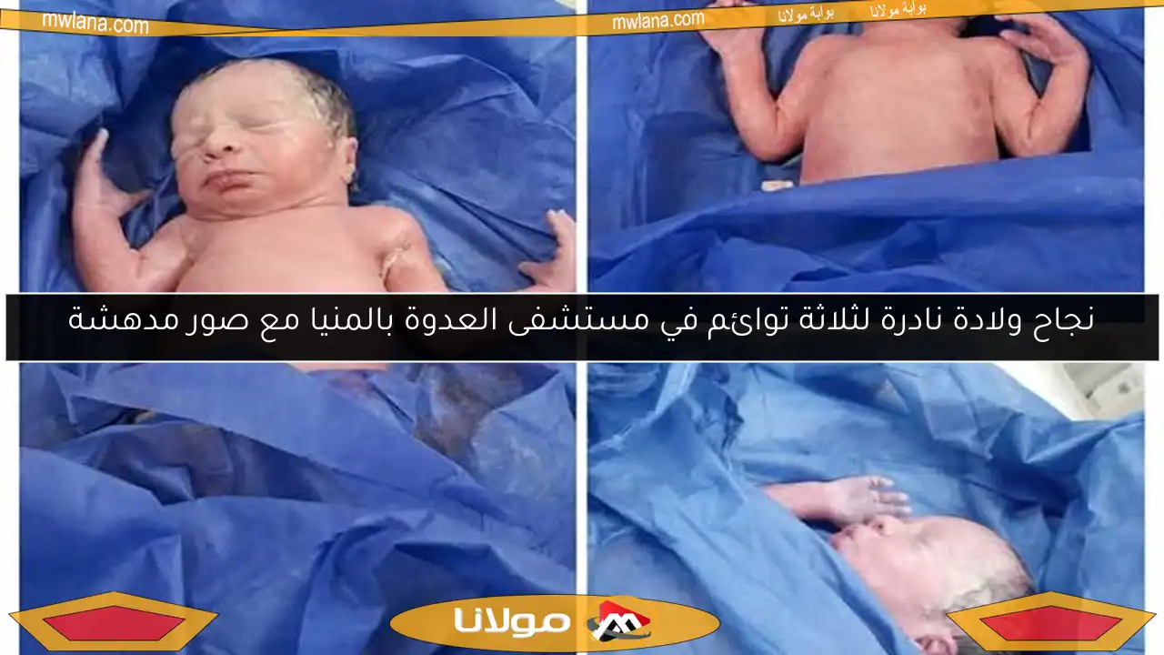 نجاح ولادة نادرة لثلاثة توائم في مستشفى العدوة بالمنيا مع صور مدهشة